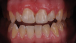 The chip blended harmoniously with surrounding dentition.