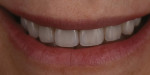 An extremely satisfied patient with her new smile.