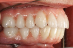 A right buccal view of the completed peripheral build-up with