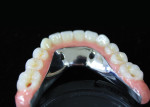 A lingual view of the finished mandibular acrylic and composite implant-supported hybrid.