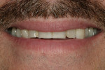 Figure 1  The patient’s smile from a conversational distance reveals a reverse smile line and teeth that are shorter than ideal proportions.