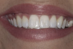 Figure 1 Preoperative photograph. The patient wanted a brighter, fuller smile.