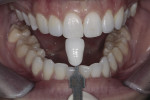Figure 2 Preoperative photograph with the desired shade tab.
