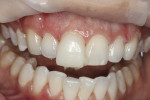 Figure 9 Placement of all veneers prior to curing.