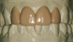Figure 7  Diagnostic wax-up of tooth Nos. 7 through 10 restoring clinical crown length and providing greater anatomic detail of line angles and embrasures.