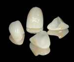 Figure 11  CAD-CAM leucite-reinforced restorations for tooth Nos. 7 through 10.