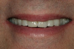 Figure 14  Patient’s smile reflects the esthetic benefits of the completed restorations.