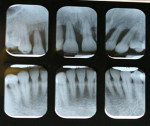 Figure 2  Anterior periapical radiographs showing marked bone loss in the maxillary anterior sextant.