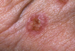 Figure 2. Basal cell carcinoma (BCC).
