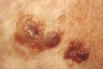 Figure 3. Squamous cell carcinoma (SCC).