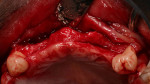 Figure 5  Occlusal view after initial flap reflection showing ridge deficiency.