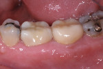 Figure 17. Despite improvements in opacity and esthetics, the lack of a layering porcelain compromises high esthetics; however, durability and lack of delamination make these restorations a good value to the patient.