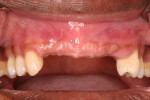 Figure 10  Buccal view 6 months post-augmentation of the pre-maxilla.