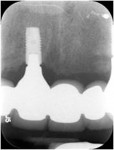 Figure 19  Final radiographs upon FPD delivery of No. 8 implant with minimal crestal bone loss after 1 year in function with the provisional restoration.