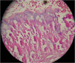 Figure 21  Histologic findings from a serial section of the bone core taken with a trephine during reentry at the site augmented with the DFDBA putty allograft and resorbable collagen membrane, 63x with H&E staining. Note connective tissue, newly for