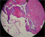 Figure 22  Histologic findings from a serial section of the bone core taken with a trephine during reentry at the site augmented with the xenograft and resorbable collagen membrane, 63x with H&E staining. Note residual graft particles (purple stainin
