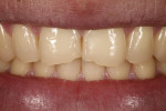 Figure 1  The maxillary central and lateral incisors exhibited wear and incisal edge breakdown due to parafunctional habits.