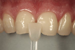 Figure 3  The monochromatic nature of the tooth color was suitable for re-restoration using a single shade of a nanohybrid composite (Nuance A2).