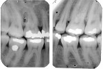 Figure 11  (Case 3) Vertical bitewings from 1997. Note mild PARR of mandibular right first molar.