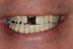 Figure 1  Preoperative smile demonstrating average lip dynamic.