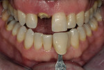 Figure 3  Base shade determination prior to treatment and tooth dehydration.
