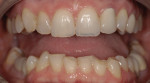 Figure 1. Excessive wear could be seen on many teeth, along with an uneven plane of occlusion.