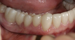 Figure 9. View of the three-unit bridge on the patient’s right side showing natural-appearing pontic in the overall occlusal scheme.