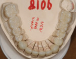 Figure 6. An occlusal view of the finished FCZ restorations on the master cast.