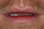 The patient shows a lack of anterior tooth display.