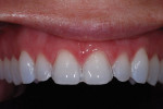 The technician should always be provided with photographs of preparations taken with the teeth wetted.