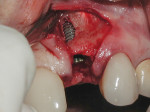 Figure 3 Immediate implant in place, showing fenestration of the buccal plate and exposed implant threads.