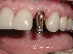 Figure 13 Stock fixture level impression coping seated. Note the gap between the impression coping and the gingival complex.