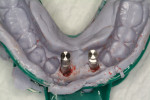 Figure 8 Two implant replicas fastened to the impression copings prior to pouring the model.