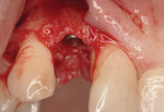 Figure 15 Immediate placement of a 3-mm x 13-mm OsseoSpeed implant.