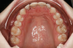 Figure 5 Upper arch, pre-treatment, with bonded retainers on lingual surfaces.