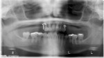 Figure 2  Panoramic radiograph as patient initially presented.