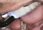 Figure 17 With the clear VPS matrix still in place in the mouth, the BFEP restorations are cured from the posterior to anterior.