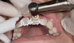 Figure 19 Polishing paste and felt cups are used to polish the facial surface of the BFEP composite restorations.