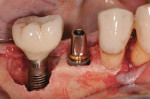 Figure 7 Implant placement No. 29 site, stock titanium abutment.