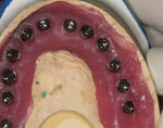 Figure 10  Laboratory soft-tissue model with: abutments on (Fig 10), metal framework (Fig 11), and provisional restoration (Fig 12)