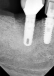 Figure 18 Two-month post-treatment periapical radiograph.
