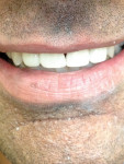 Figure 2 Patients can experience transforming their smile in one visit.