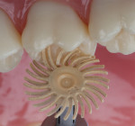 Figure 2 3M ESPE Sof-Lex spiral wheels finish and polish direct and indirect restorations and flex to conform to convex and concave surfaces.
