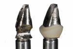 A metal abutment was chosen because of its physical properties, and a ceramic margin was used to aid the transmission
of light into the tissue around tooth No. 11.