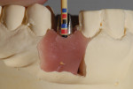 The custom abutment for implant crown No. 11, showing the abutment’s contour.