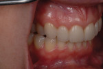 The shade match of the porcelain restorations was excellent when compared to the patient’s natural teeth.