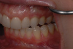 The tissue around the implant-supported crown No. 11 was pink and healthy and exhibited good light transmission at the gingival margin.
