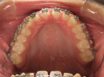 Maxillary arch view during orthodontic treatment.