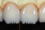 Troughed areas were carefully stained with a mixture of IPS e.max Incisal 2 (violet) and Universal Grey.