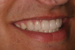 Postoperative natural smile right lateral view.